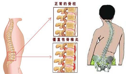 强直性脊柱炎患者