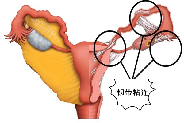 韧带粘连_副本