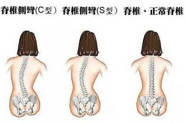 先天性脊柱侧弯