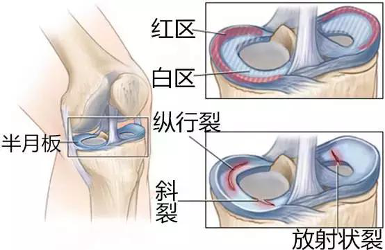 半月板损伤