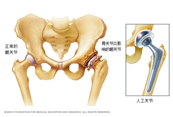 骨关节炎