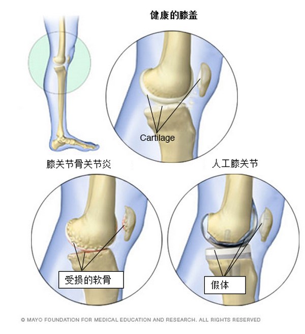 骨关节炎的治疗办法,看完这一篇就能全部知道-腿友之家