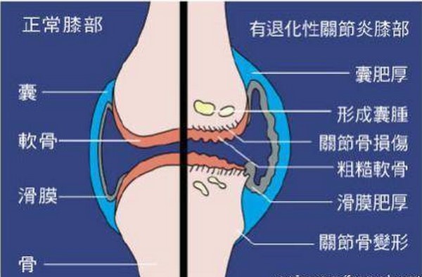 膝关节退行性病变