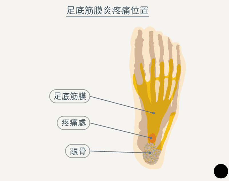 带你认识足底筋膜炎