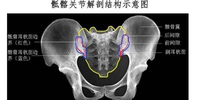 骶髂关节炎