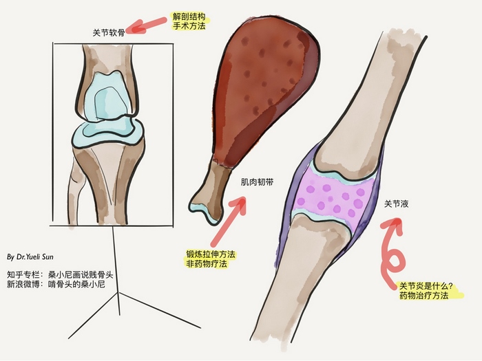 膝骨关节炎的常见症状，自我治疗