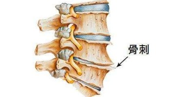 骨刺治疗