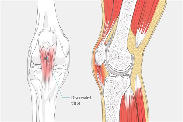 髌腱炎
