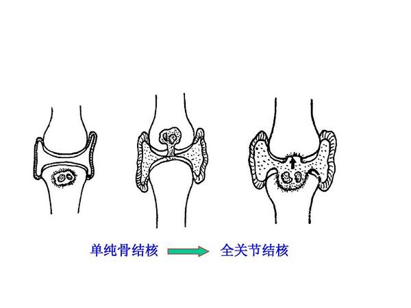 骨结核的四大症状