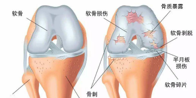 退行性关节炎有哪些症状？