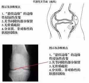 膝关节炎